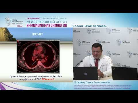 Видео: Современные стандарты хирургического лечения рака легкого.
