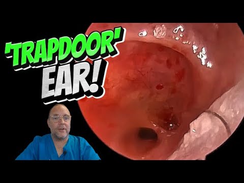 Видео: Ухо-«люк»! 356 #ухо #ушнаясера #удалениеушнойсеры #удалениеушнойсеры #удалениеушнойсеры #удовлетв...