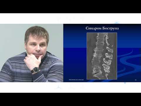 Видео: Спондилоартроз в практике врача. Клиника, нейровизуализация и лечение. Клинический практикум по боли