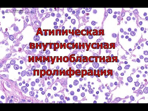 Видео: Атипическая иммунобластная внутрисинусная пролиферация