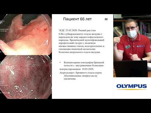 Видео: Ранний рак субкардинального отдела желудка. С. В. Кашин, Е. А. Крайнова, С. С. Пирогов
