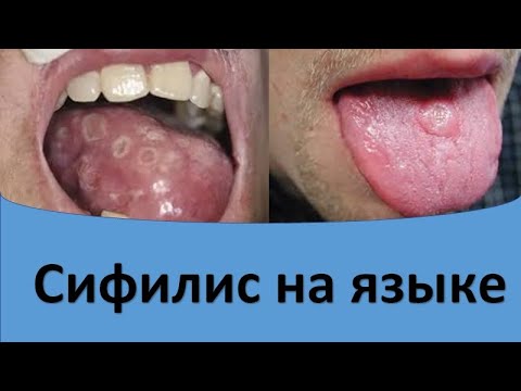 Видео: Сифилис на языке