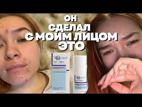 Видео: как я вылечила кожу? акне. моя история.