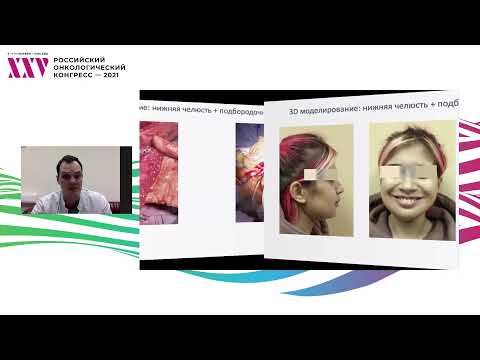 Видео: Применение технологии CAD/CAM при планировании реконструкции нижней челюсти