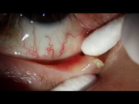 Видео: Удаление камня из глаза... Я не ожидал, что это так вырвется!
