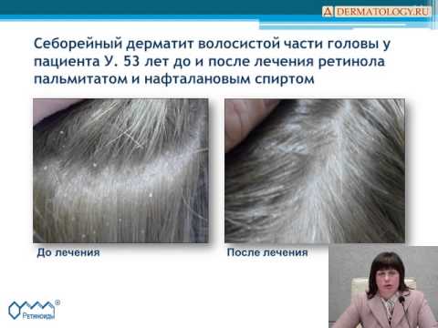 Видео: Новый подход к лечению себорейного дерматита
