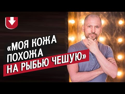 Видео: Люди с ихтиозом | Неудобные вопросы