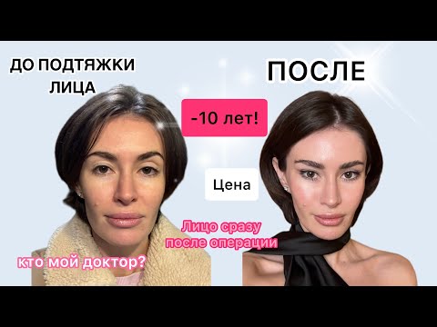 Видео: Подтяжка лица в 31 год. Зачем так рано?  Кто мой врач? Сколько стоит?