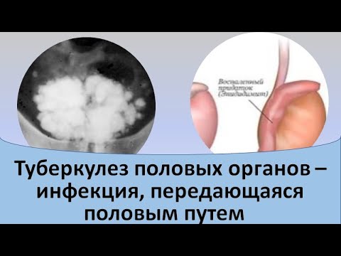 Видео: Туберкулез половых органов  - инфекция, передающаяся половым путем