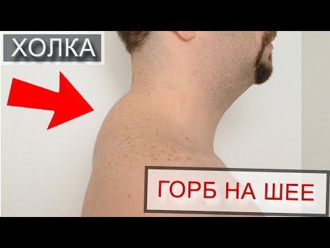 Видео: Холка на шее - вдовий горбик (гормональный горбик, климактерический, эстетический). Радион Игнатьев