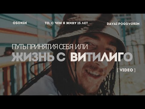 Видео: 15 лет с ВИТИЛИГО или мой путь ПРИНЯТИЯ