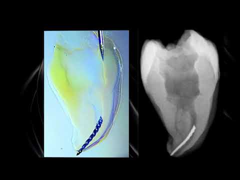 Видео: Оценка сложности клинического случая с фрагментом сломанного инструмента в корневом канале.