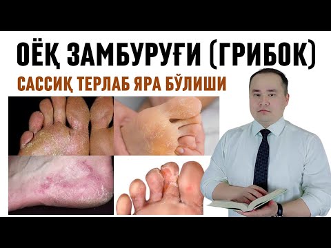 Видео: ОЁҚ САССИҚ ТЕРЛАБ ЗАМБУРУҒ ЯРА БЎЛИШИ ВА ДАВО ЧОРАЛАРИ ҲАҚИДА МАЪЛУМОТ / Исчанов