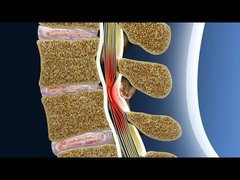 Видео: 5.  Как болит стеноз позвоночного канала