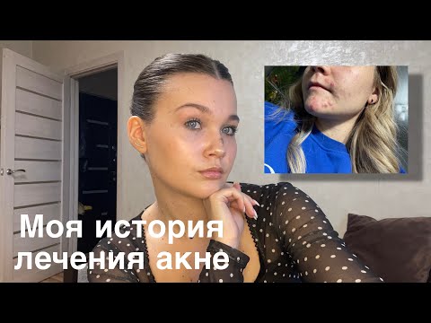 Видео: 💌МОЯ ИСТОРИЯ АКНЕ | этапы лечения, сколько это стоит, побочные эффекты