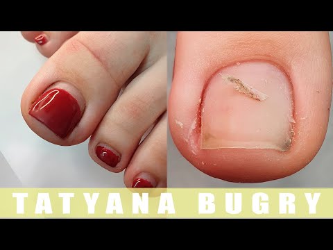 Видео: Регулярный уход за врастающими ногтями / ПЕДИКЮР / Татьяна Бугрий
