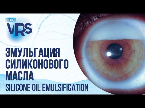 Видео: Эмульгация силиконогового масла и АГО | Silicone oil emulsification and glaucoma surgery