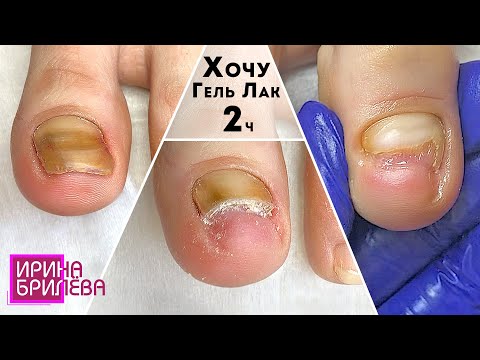 Видео: Педикюр 🌸 Что бывает, если не лечить ногти (2 часть) 🌸 Хочу покрыть ногти гель лаком 🌸 Ирина Брилёва