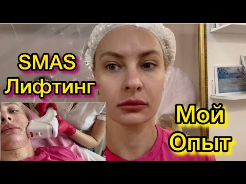 Видео: Смас лифтинг.Мой опыт, Отзыв, Побочки..#smasРостов-на-дону