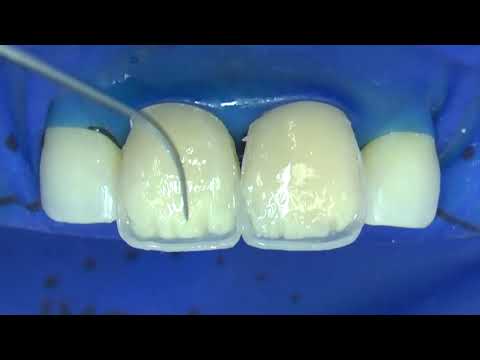 Видео: МАМЕЛОНЫ (mamelons)