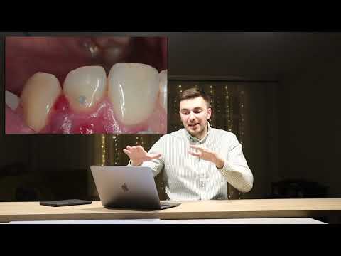 Видео: КАК СОХРАНИТЬ ЗУБ? ОРТОЭКСТРУЗИЯ