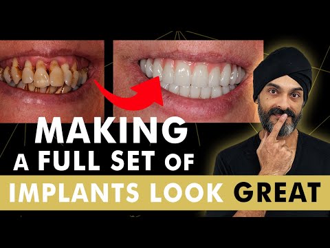 Видео: Как мы добиваемся того, чтобы полный комплект зубных имплантатов (все на 4) выглядел великолепно