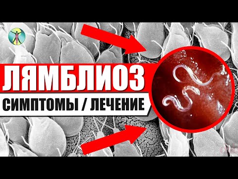 Видео: Лямблии у детей и взрослых!! Симптомы и лечение лямблиоза.