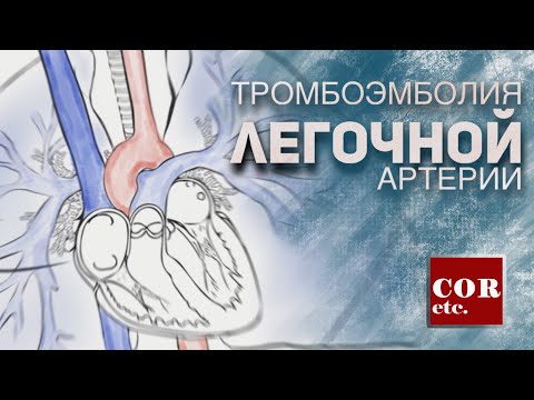 Видео: Тромбоэмболия легочной артерии (ТЭЛА).