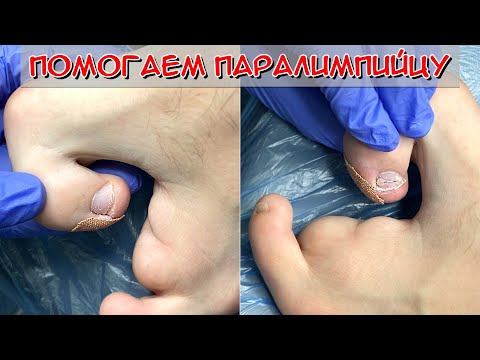Видео: Вросший ноготь паралимпийца / Установка коррекционной системы