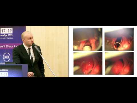 Видео: Эндоларингеальные лазерные резекции в лечении рака гортани Т1-Т2