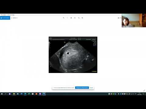 Видео: Лекция 4. УЗД ранних сроков беременности