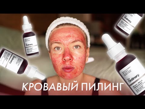 Видео: Кровавый пилинг The Ordinary AHA 30% + BHA 2% Peeling Solution | Отшелушивание | Прыщи | Проблемная