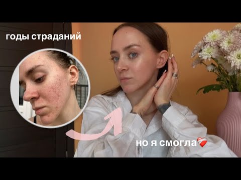 Видео: КАК я вылечила АКНЕ? Системные ретиноиды, акнекутан, эффезел