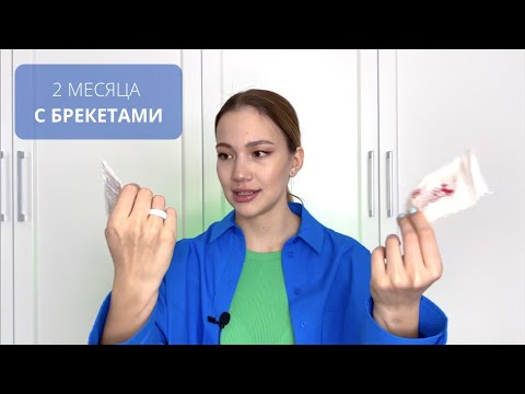 Видео: 2 МЕСЯЦА С БРЕКЕТАМИ 🦷 | ФОТО | ИЗМЕНЕНИЯ