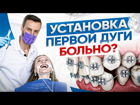 Видео: Установка первой ортодонтической дуги. Больно или нет? Рекомендации доктора