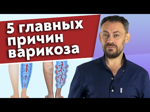 Видео: Что такое варикоз? / Основные причины варикозного расширения вен