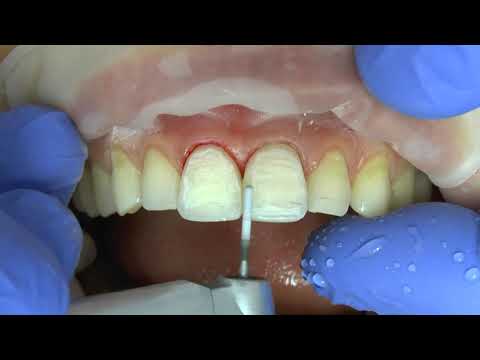 Видео: Finishing protocol in direct restoration. Финишная обработка композитной реставрации.