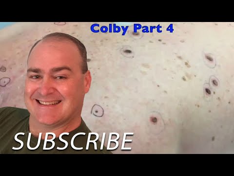 Видео: Расширенные поры Винера?