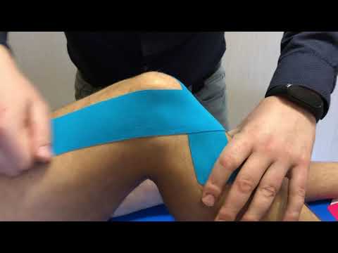 Видео: Наложение кинезио тейпа на крестообразные связки коленного сустава.