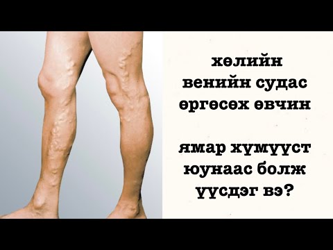 Видео: варикоз буюу хөлийн венийн судасны тэлэгдэлт өвчний үед ямар шинж тэмдэг илэрдэг вэ?