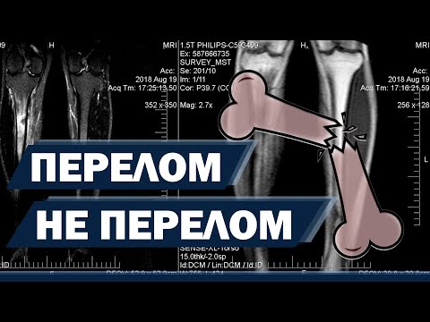 Видео: Стресс перелом. Отек кости. Что это такое и как лечить? | Доктор Демченко