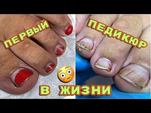 Видео: Желтые ногти 😨 Педикюр впервые в жизни 💅 Обработка ногтей