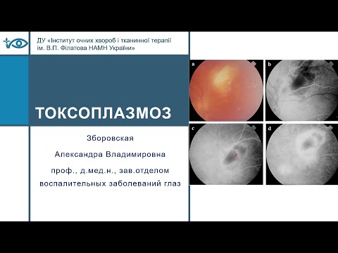 Видео: Токсоплазмоз и токсоплазмозное поражение глаза