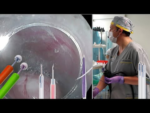 Видео: Подслизистая диссекция. Запись прямой трансляции из НМИЦ онкологии им. Н. Н. Блохина