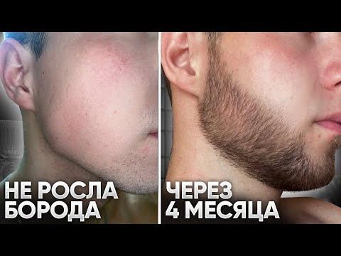 Видео: Результаты Ксиноксина для роста бороды / Прошел откат в армии и начал снова