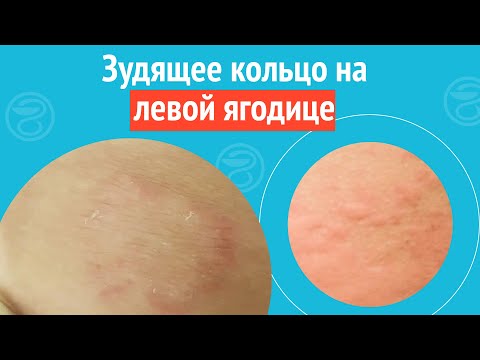 Видео: 💍 Зудящее кольцо на левой ягодице. Клинический случай №1169