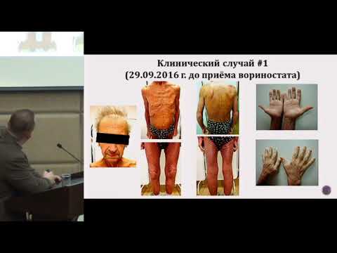 Видео: Коломейцев О.А., Возможности ведения пациентов с поздними стадиями грибовидного микоза ..