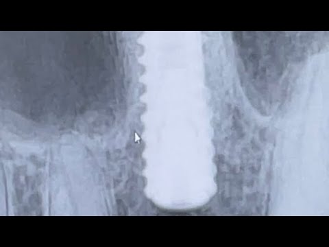 Видео: Закрытый синус лифтинг. Использование перегородок гайморовой пазухи