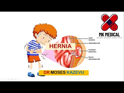 Видео: Паховая грыжа