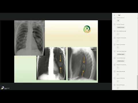 Видео: Лучевая диагностика рака легкого